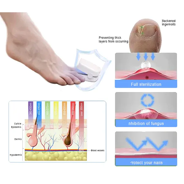 Oveallgo™ NanoPRO Revolutionary High-Efficiency Light Therapy Device For Toenail Diseases